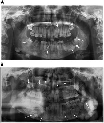 Case report: Initial atypical skeletal symptoms and dental anomalies as first signs of Gardner syndrome: the importance of genetic analysis in the early diagnosis